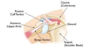 diagram of a biceps tendon shoulder tear