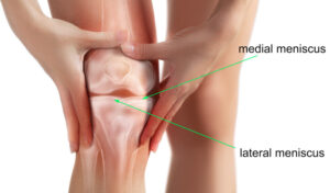 diagram of a meniscus tear