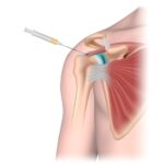 shoulder joint injections